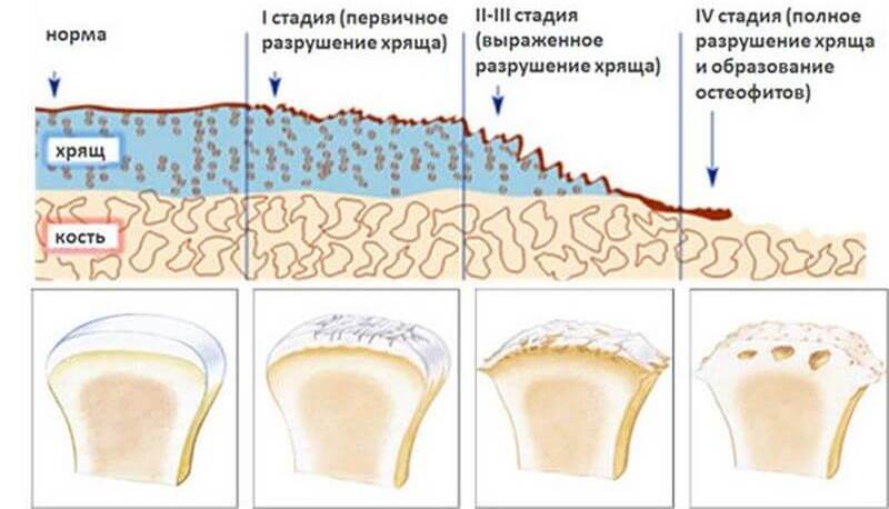 Деформирующий артроз фото