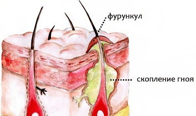 Причины возникновения фурункула носа
