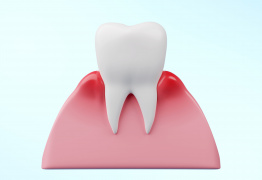 Гингивит - лечение воспаления десен полости рта — ROOTT